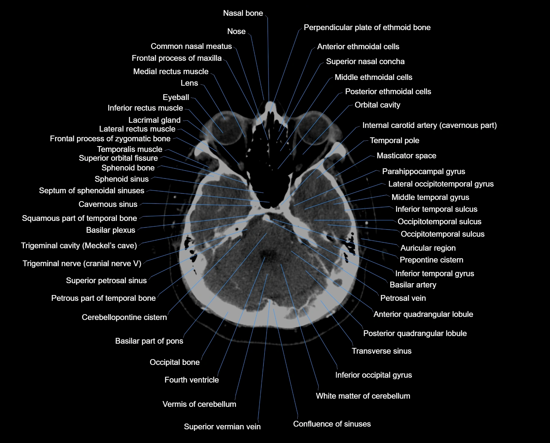 CT scan brain axial labelled cross sectional anatomy image-img-000020.webp